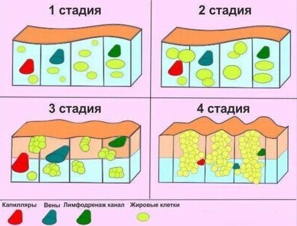 Стадии целлюлита в картинках 4